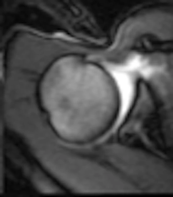 Dynamic Mri Mass Dynamic MRI techniques detail patterns, problems in shoulder motion ...