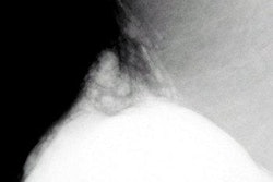 Augment1