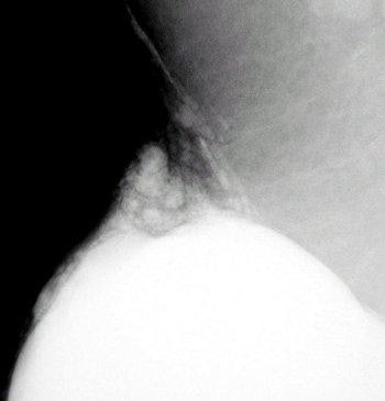 Augment1