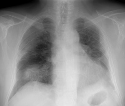 08290111230622 Cxr After Antibiotics Small