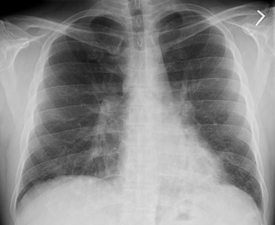 08290111231194sm Cxr