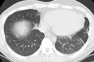 08290111231569sm Ct Post Steroids