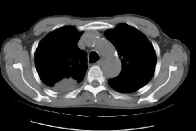 08290111235314 Chest Wall Invasion