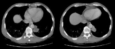 08290111235584 No Aortic Invasion S