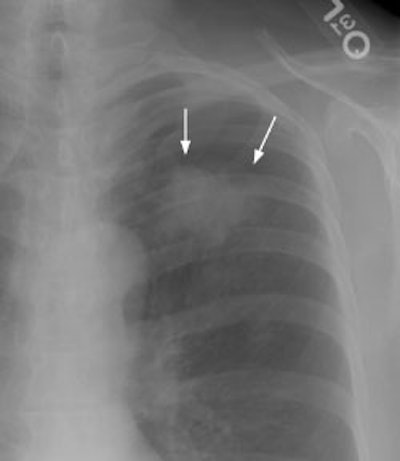 08290111235861 Ptx And Lesion Moves S