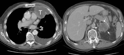 08290111240152 Adrenal Met S