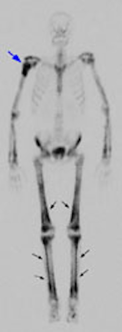 08290111240438 Hoa Bone Scan S