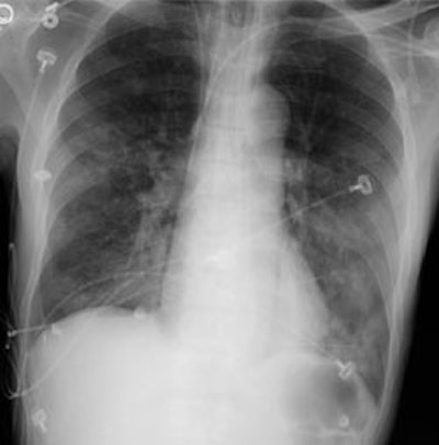 08290111244330 Cxr Sm