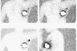 08290111245312 Sentinel Node