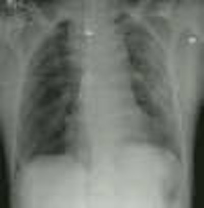 08290111245696aorta1a