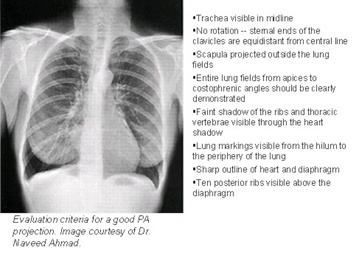 Angle of Louis, transverse thoracic plane, with radiograph! (anatomy) 
