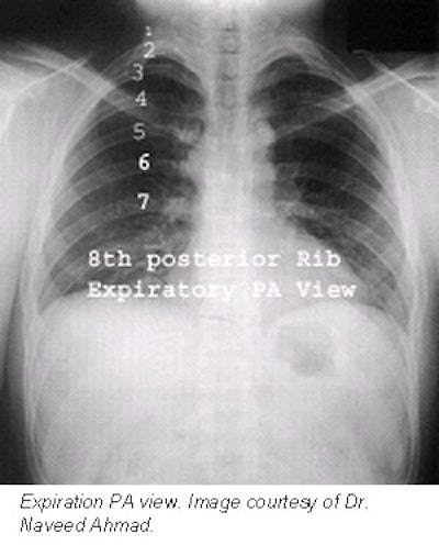 Woman's chest muscles from neck down to waist under a blue x-ray