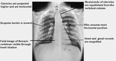 Anatomic markers for measures of lower thoracic excursion using a cloth