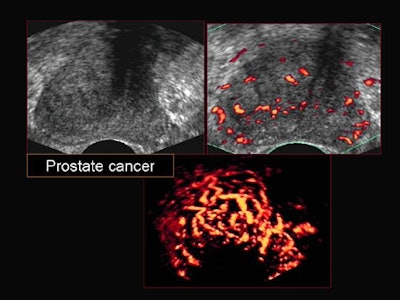 Adding 3-D to power Doppler US improves prostate cancer detection