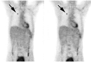 1cm_lesion.JPG (12496 bytes)