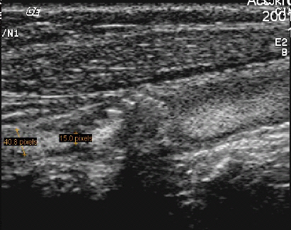 B-flow Ultrasound Shows Promise In Carotid Artery Imaging | AuntMinnie