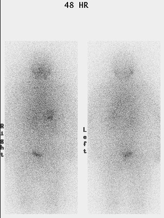 48 Hr I131