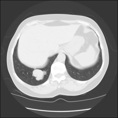 Avm Large Ct