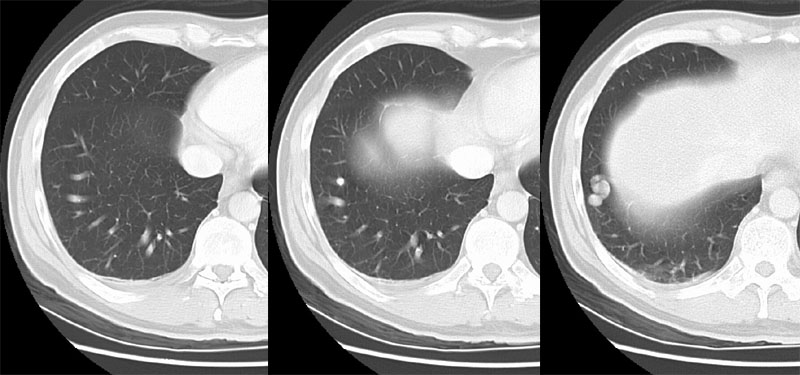 /ScottWilliamsMD2/CHEST/Tumor/Benign/AVM/Images/Case2/avm.jpg (72642 bytes)
