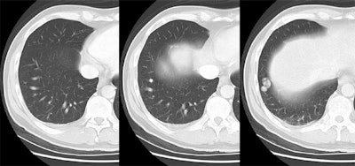 /ScottWilliamsMD2/CHEST/Tumor/Benign/AVM/Images/Case2/avm.jpg (72642 bytes)