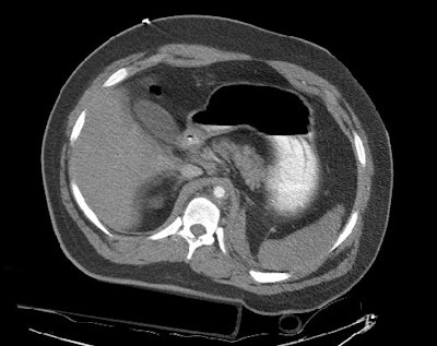 Abd Aorta