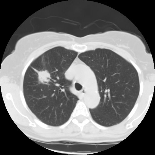 Adenoca W Air Bronchogram