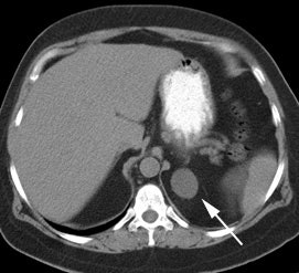 Adenoma Ct