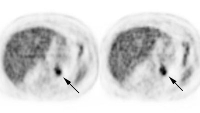 PET > PET tumor imaging > General | AuntMinnie