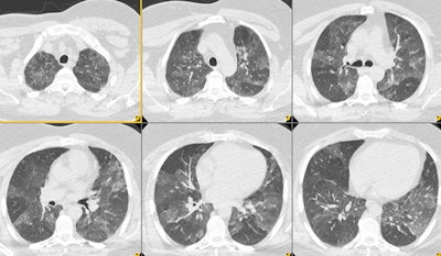 Air Trap Expiration Sm