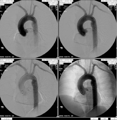 /ScottWilliamsMD2/CHEST/Vascular/Dissection/Images/TypeA/Case3/angio.jpg (89893 bytes)
