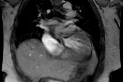 /ScottWilliamsMD2/CHEST/Cardiac/Valve/AS/Images/Case1/animation18.gif (893598 bytes)