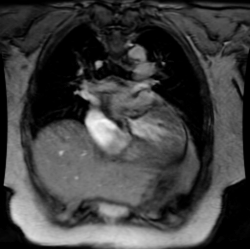 /ScottWilliamsMD2/CHEST/Cardiac/Valve/AS/Images/Case1/animation18.gif (893598 bytes)