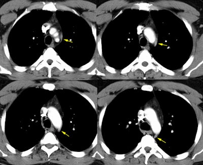 Aortic Nipple On Ct Small