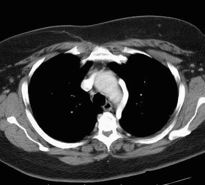 Aorticnipple Ct Lg