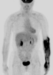 PET > PET tumor imaging > General | AuntMinnie