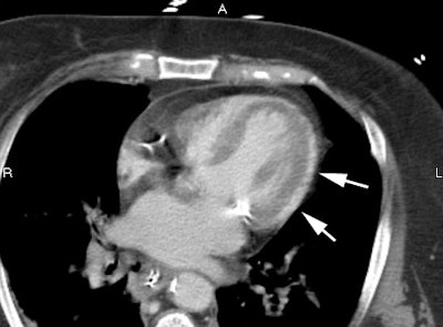 Axial Enhance Epicardium