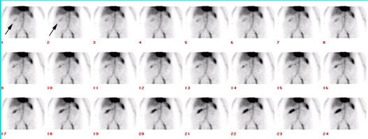 Gastrointestinal > RBC imaging | AuntMinnie