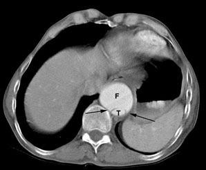 /ScottWilliamsMD2/CHEST/Vascular/Dissection/Images/CT_false_true/beak_sign.jpg (19784 bytes)