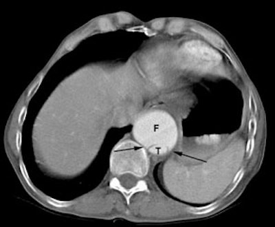 /ScottWilliamsMD2/CHEST/Vascular/Dissection/Images/CT_false_true/beak_sign.jpg (19784 bytes)