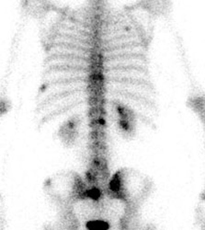 Bone Met Bone Scan