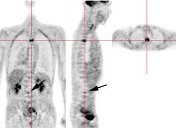Bone Mets 1
