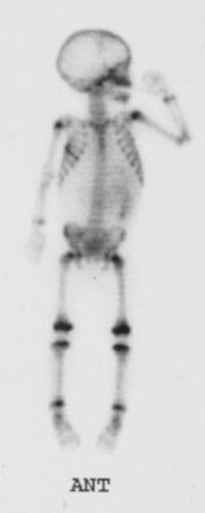 Bonescan_Neuroblastoma1.jpg (7207 bytes)