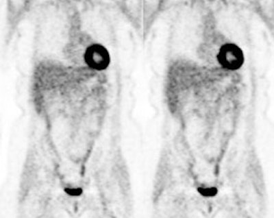 PET > PET tumor imaging > General | AuntMinnie