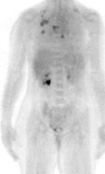 Breast_node_mets.JPG (5995 bytes)