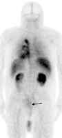 CEA-Scan 4hr whole body.jpg (1447 bytes)