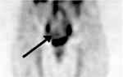 /ScottWilliamsMD2/NucMed/Tumor/CEA-scan/Cytogen%20cases/cea1.jpg (1293 bytes)