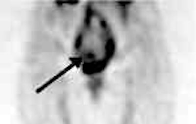 /ScottWilliamsMD2/NucMed/Tumor/CEA-scan/Cytogen%20cases/cea2.jpg (1261 bytes)