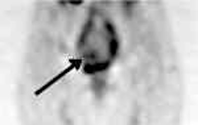 /ScottWilliamsMD2/NucMed/Tumor/CEA-scan/Cytogen%20cases/cea3.jpg (1260 bytes)