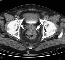 Cea Ct2 Sm