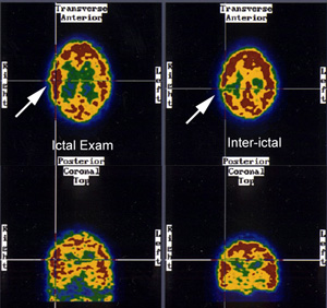 CNS seizure1_sm.JPG (50964 bytes)